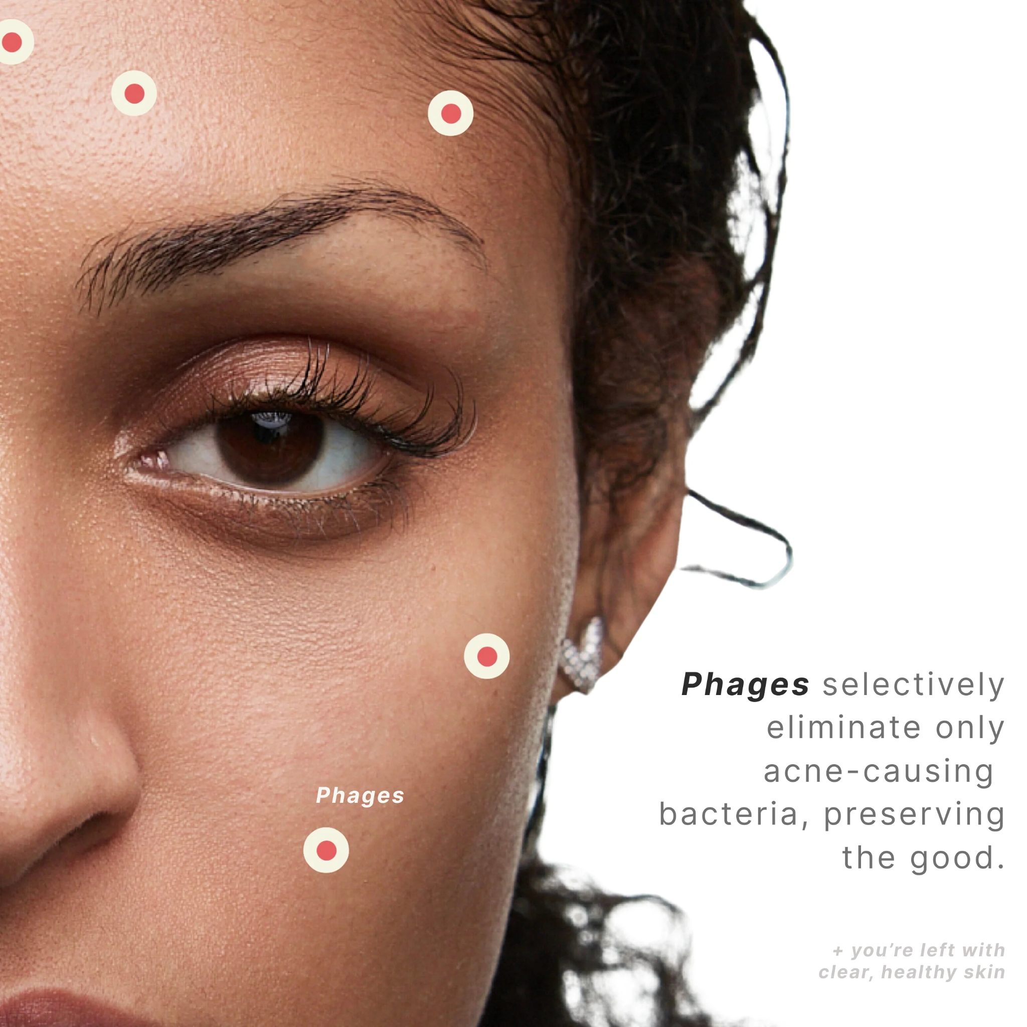 Phyla Acne Phage System Kit - Image 2