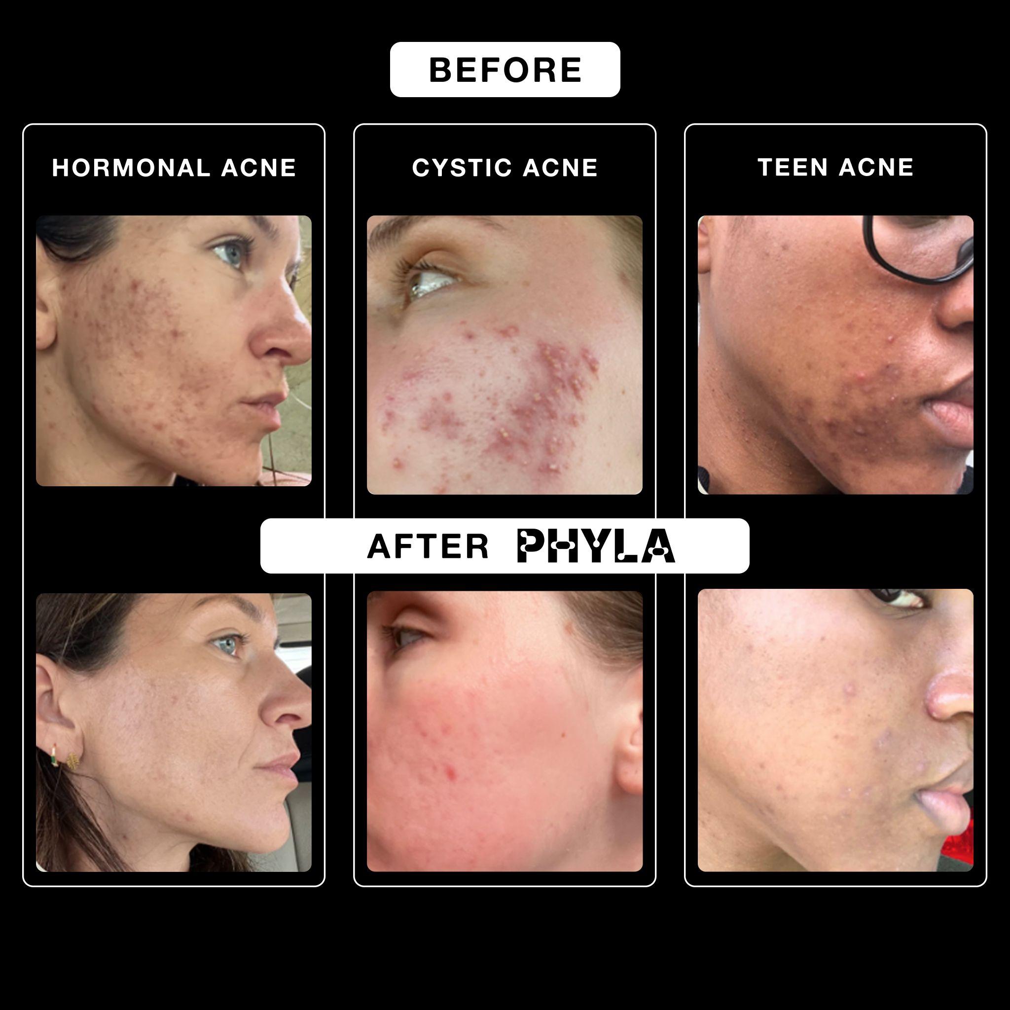Phyla Acne Phage System Kit - Image 5